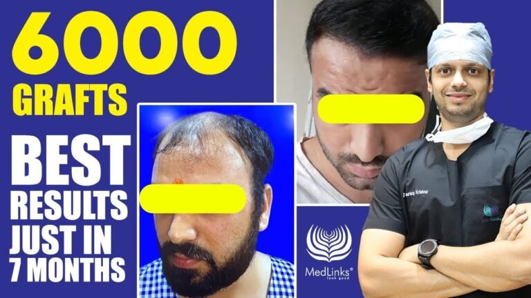 Hair Transplant Cost in Hyderabad